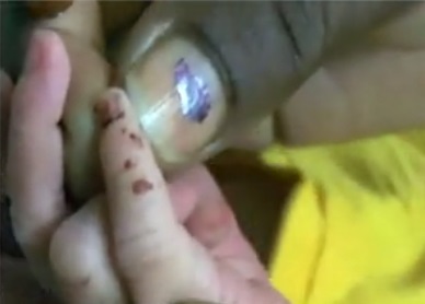 مدھیہ پردیش: سرکاری ہسپتال میں چوہوں نے نومولود بچی کی انگلی كتری