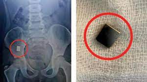 مہاراشٹر میں کالونوسکوپی کے ذریعے 4 سالہ بچی کے جسم سے مقناطیس نکالا گیا