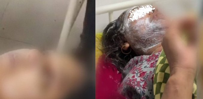 بہار میں ماں بیٹی پر تیزاب حملہ، زیورات لینے گئی مسلم خاتون اور بیٹی شدید زخمی