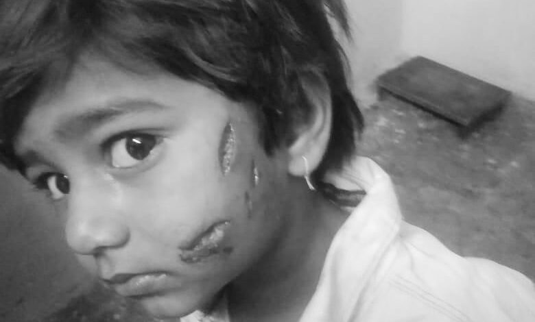 حیدرآباد: آوارہ کتے نے پانچ سالہ بچے پر حملہ کر دیا