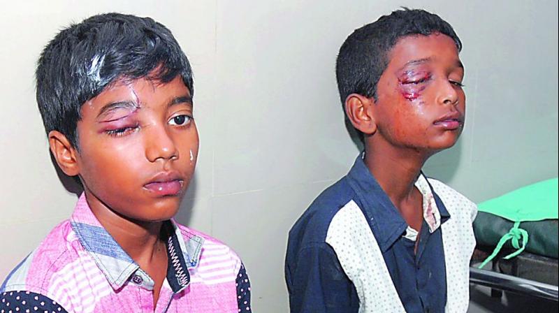 دیوالی سے متعلقہ آنکھ کی چوٹیں تلنگانہ میں بڑھ رہی ہیں، حیدرآباد کے سروجنی دیوی  اسپتال میں اچانک آشوب چشم کے پھیلنے کی اطلاع ہے
