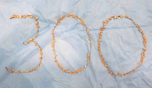 بزرگ مریض کے گردے سے 300 پتھریاں نکالی گئیں