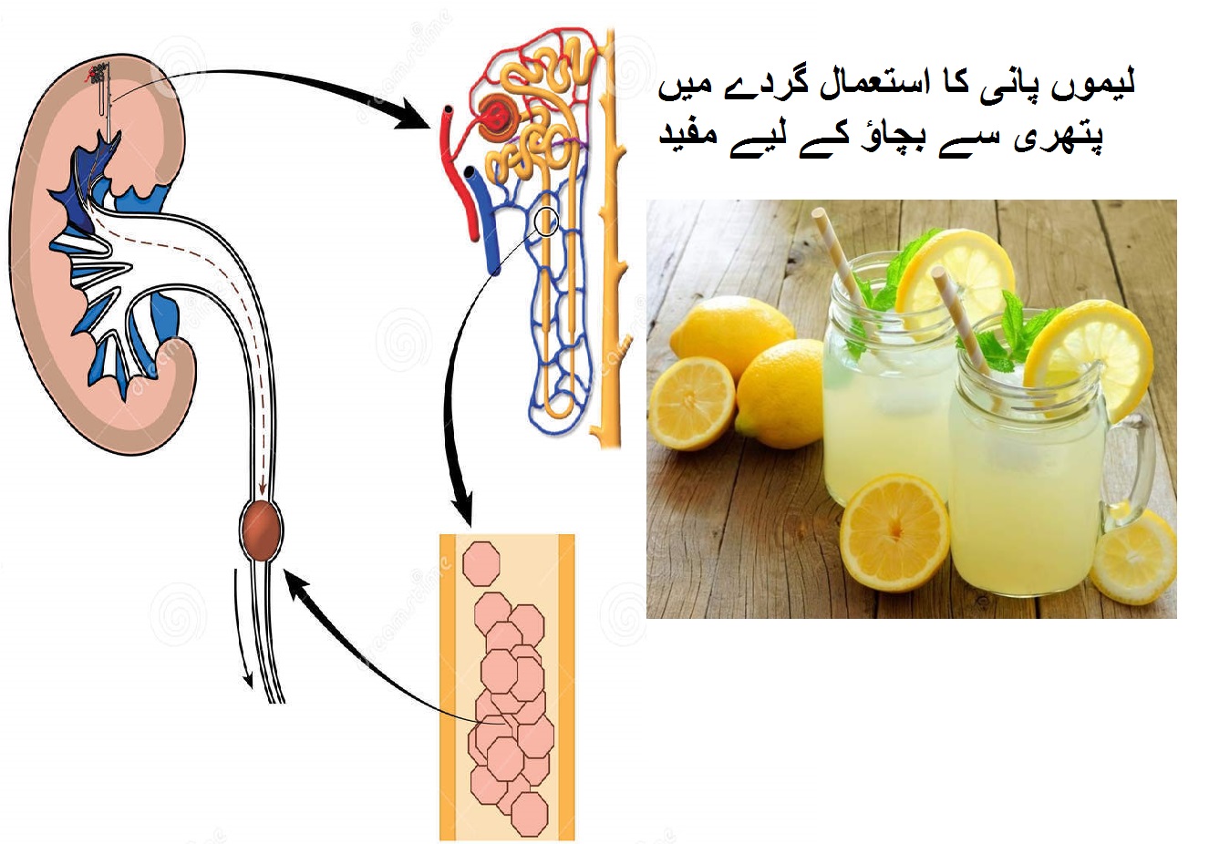 لیموں پانی کا استعمال گردے میں پتھری سے بچاؤ کے لیے مفید 