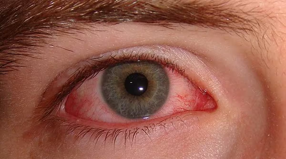 آنکھوں کے وائرس سے بچنے کے لیے کیا احتیاط کرنی چاہیے؟