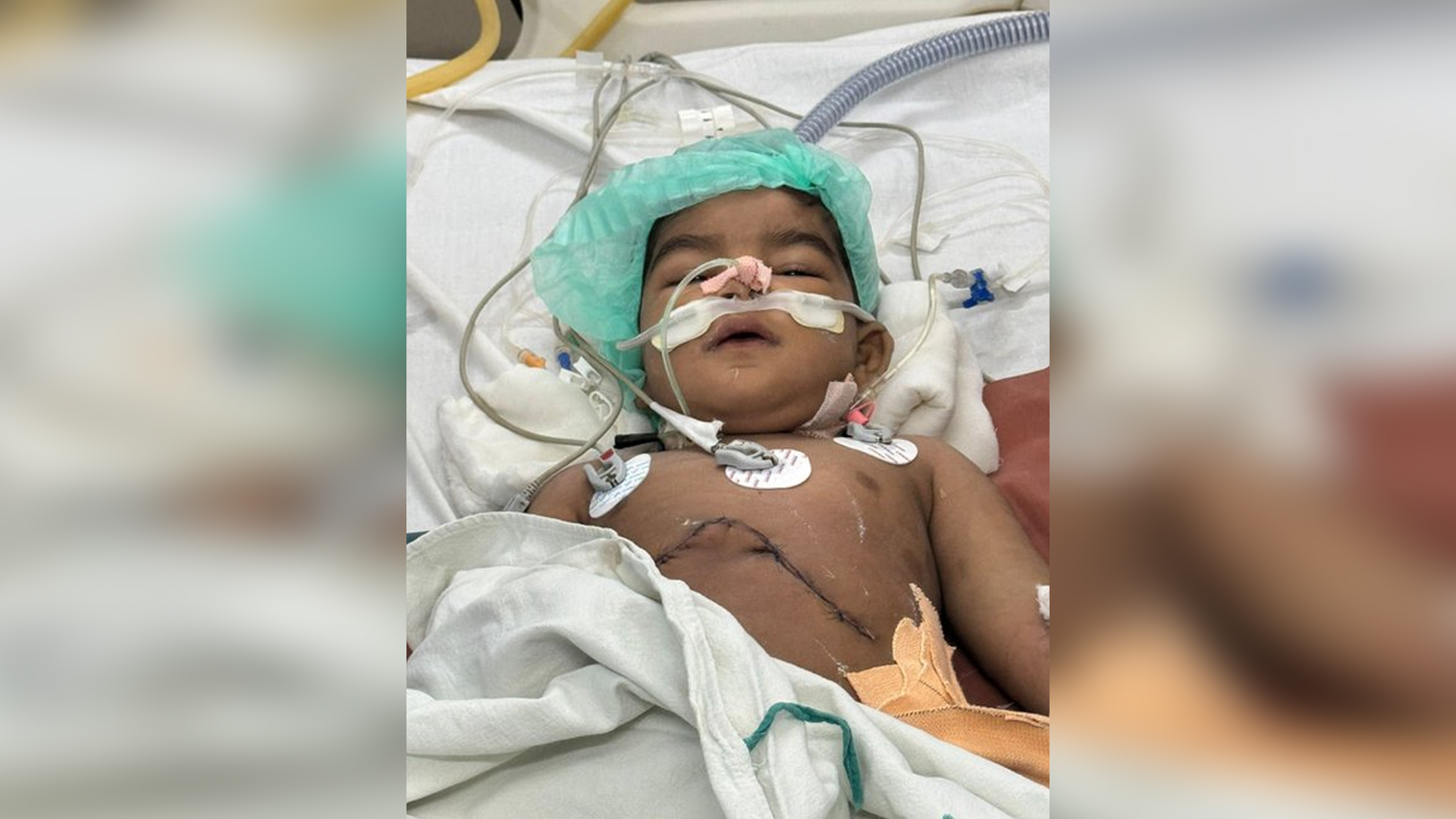 حیدرآباد کے عثمانیہ اسپتال میں 18 ماہ کے بچے کا کامیاب لیور ٹرانسپلانٹ