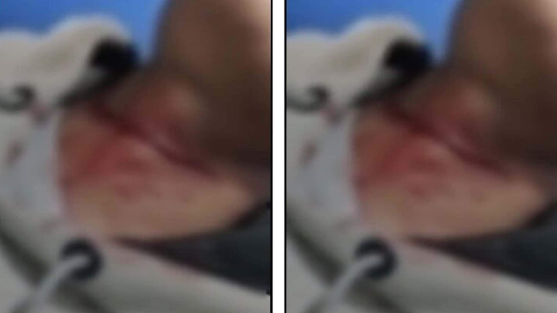 حیدرآباد میں ممنوعہ چینی مانجہ سے نوجوان شدید زخمی، حالت نازک