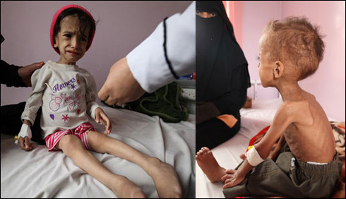 13 لاکھ یمنی بچے غذائی قلت کا شکار ،اسپتالوں میں دوائیں ختم  